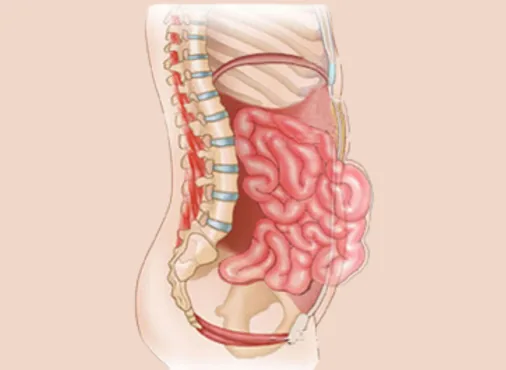 Complex Abdominal Wall Hernia consultation at Niraaya Hospital